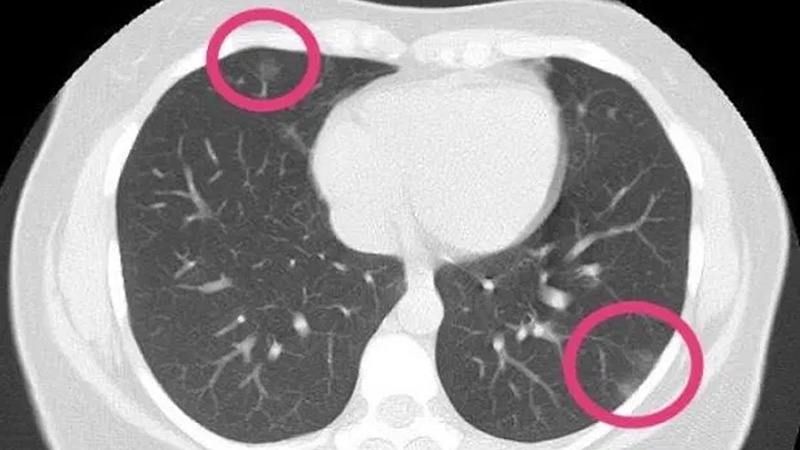 Chụp CT phổi là phương pháp chẩn đoán, phát hiện bất thường với độ chính xác cao